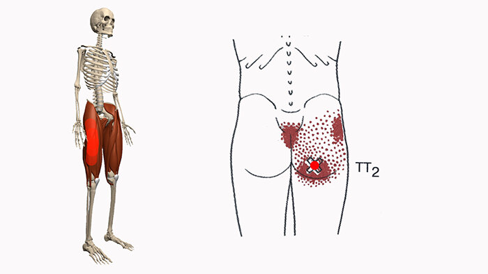 Триггерные точки мышц таза. Триггерные точки тазобедренного сустава. Триггерные точки области тазобедренного сустава. Триггерные точки передняя поверхность бедра.