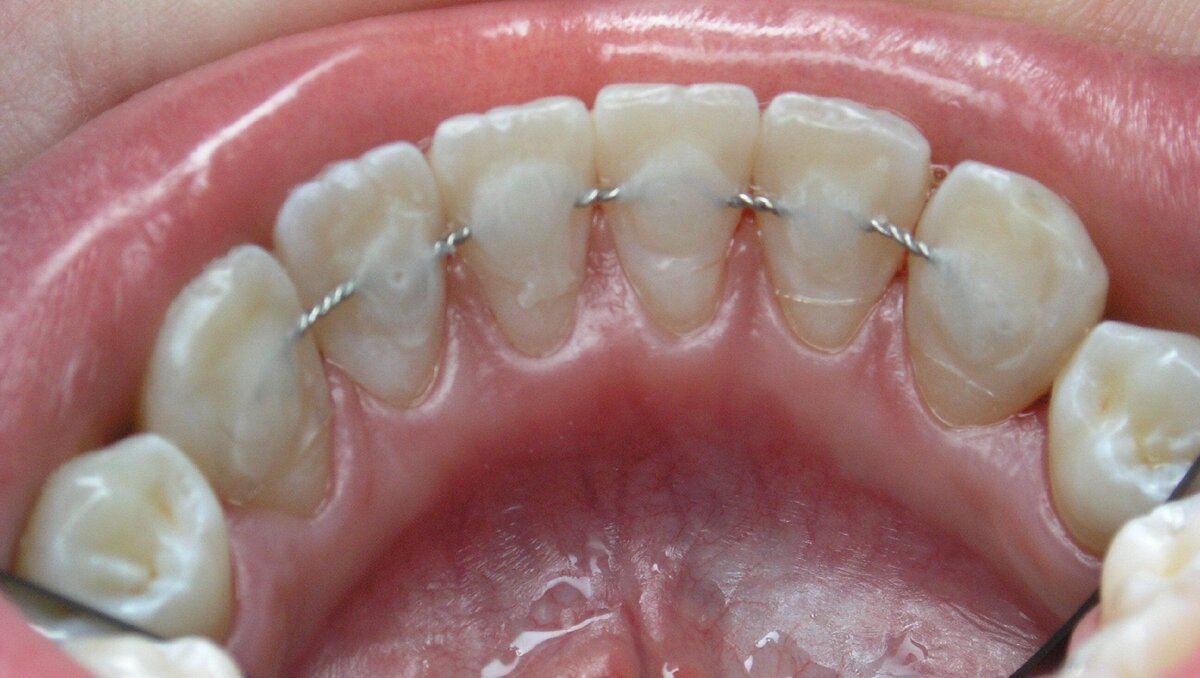 Шатаются зубы что делать? Как избавиться от зубной подвижности