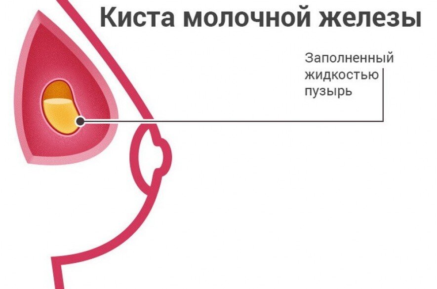 Киста молочной железы – причины появления, виды и методы лечения