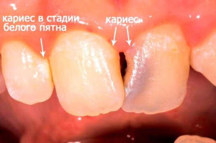 B007109 Заглушка декоративная под отверстие D10, темно-коричневая