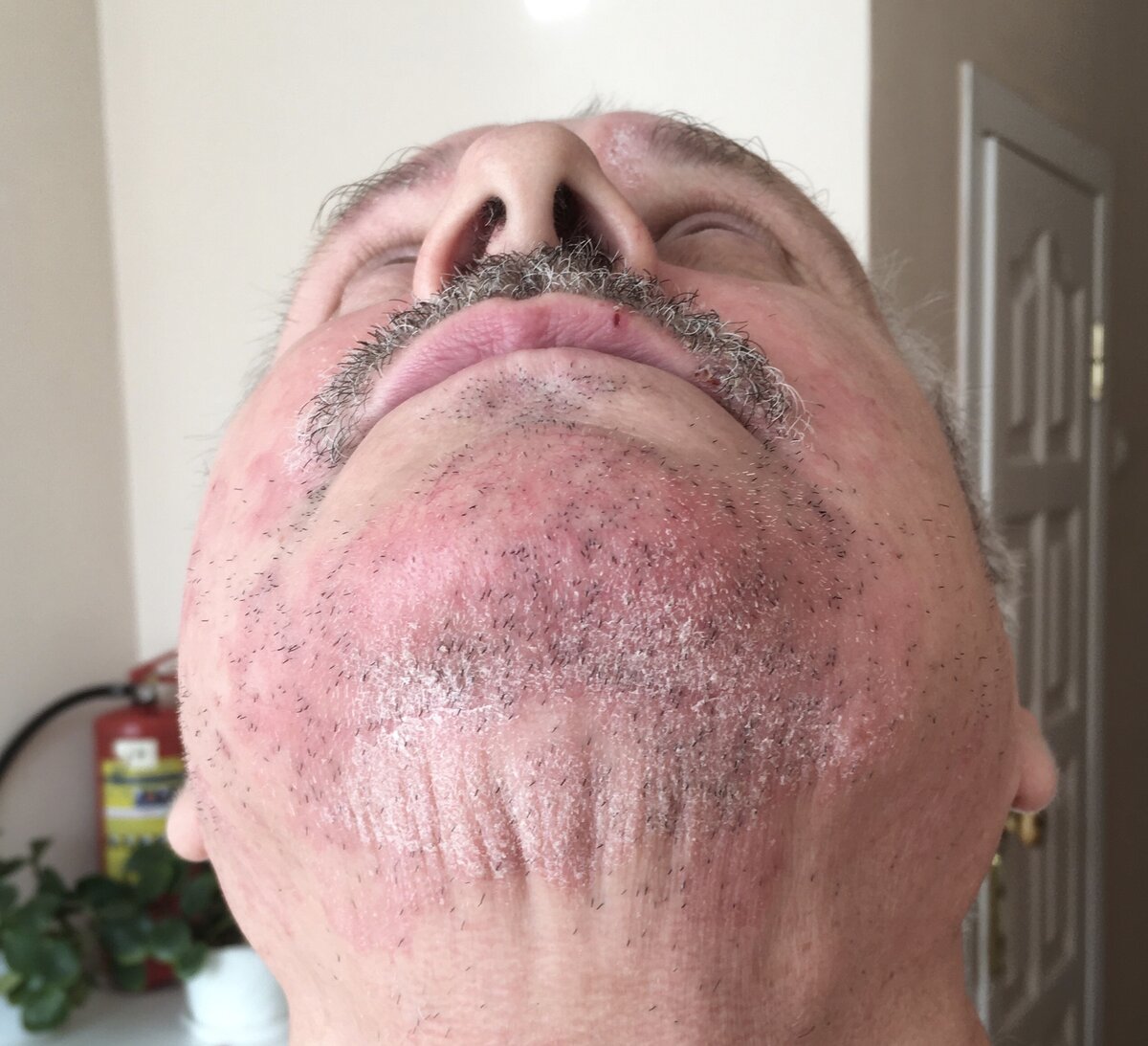 Объективно: одиночные и сливные эритемато-сквамозные (покрасневшие и покрытые чешуйками) пятна с синюшным оттенком, с прерывистым, валикообразным краем (окантовкой), состоящим из  мелких папул и пустул (бугорков и гнойничков), корочек на коже подбородка, передней и боковых поверхностях шеи и  щёк.