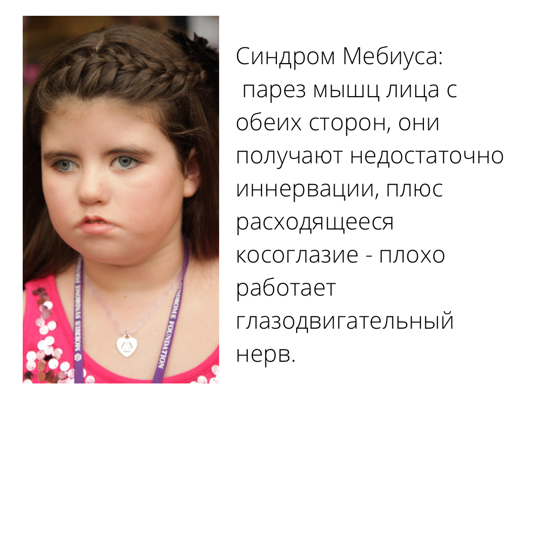 Источник фото: https://moebiussyndrome.org/about-moebius-syndrome/for-infants-and-children-living-with-moebius-syndrome/
