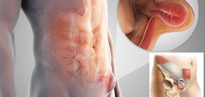 Грыжа – это заболевание, при котором органы брюшной полости (петли кишечника, сальник, мочевой пузырь и т.д.) выходят за ее пределы через слабые места брюшной стенки. 