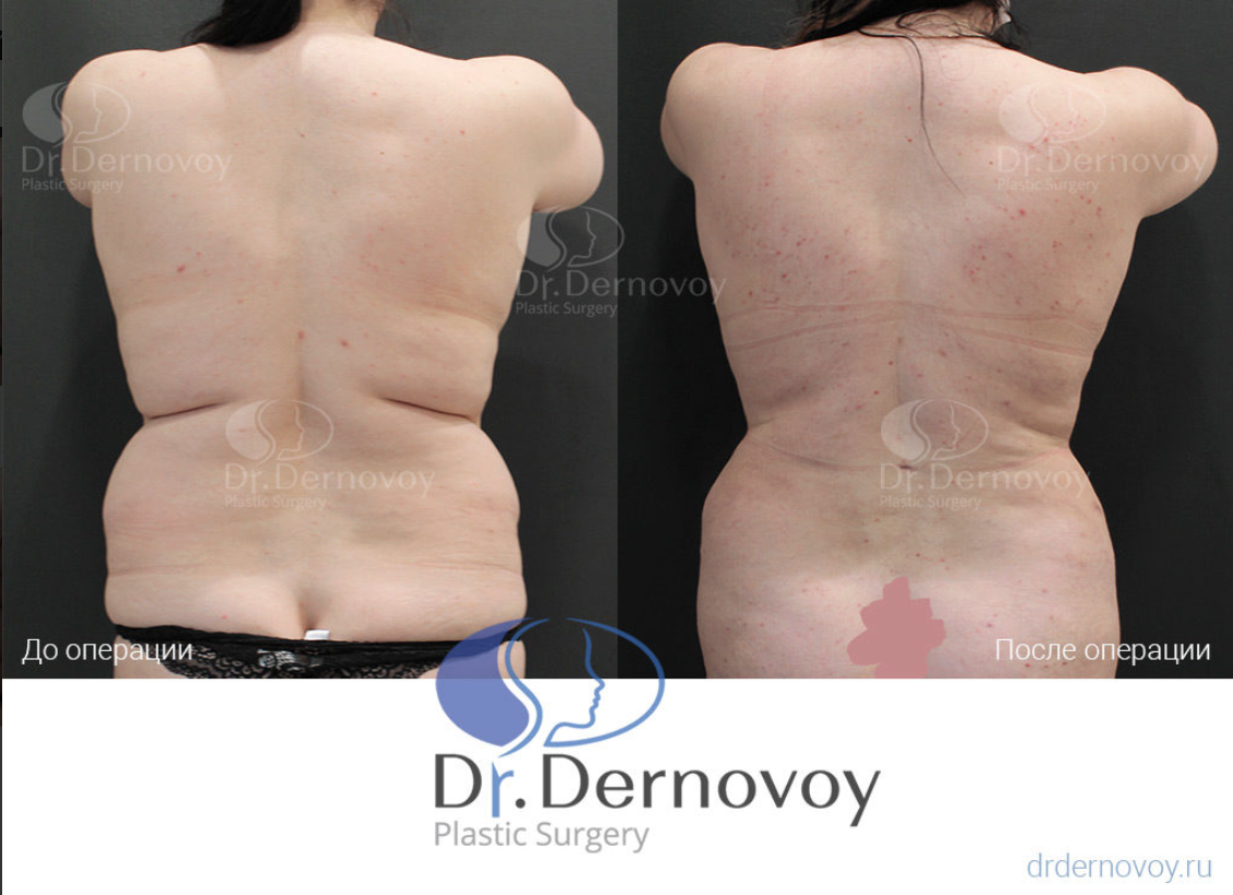 Липофилинг спины - пластический хирург Сергей Дерновой