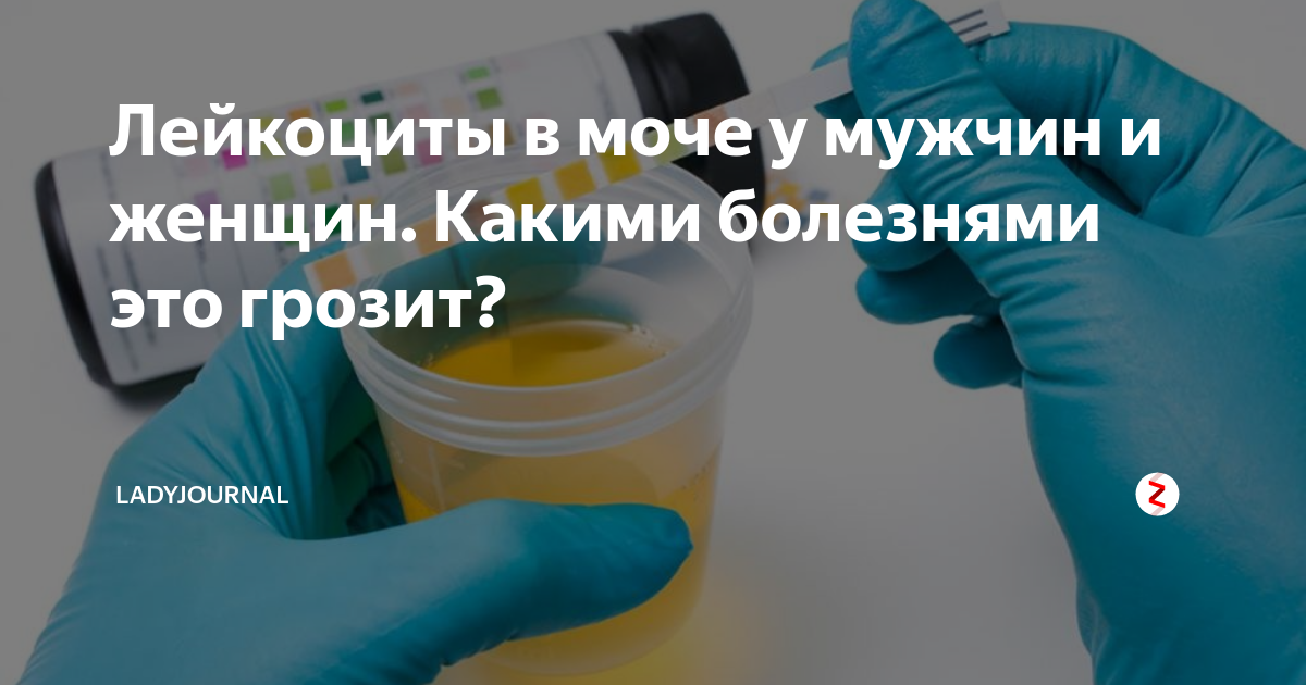 Лейкоциты в моче сильно. Повышенные лейкоциты в моче. Лейкоциты в моче повышены. Лейкоциты в моче 100 у мужчины. Высокие лейкоциты в моче.