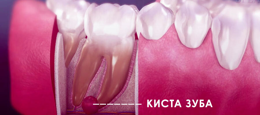  Поговорим о таком распространенном явлении в стоматологии, как киста зуба - особенности возникновения, видах, и возможностях современного лечения. Что такое киста зуба?