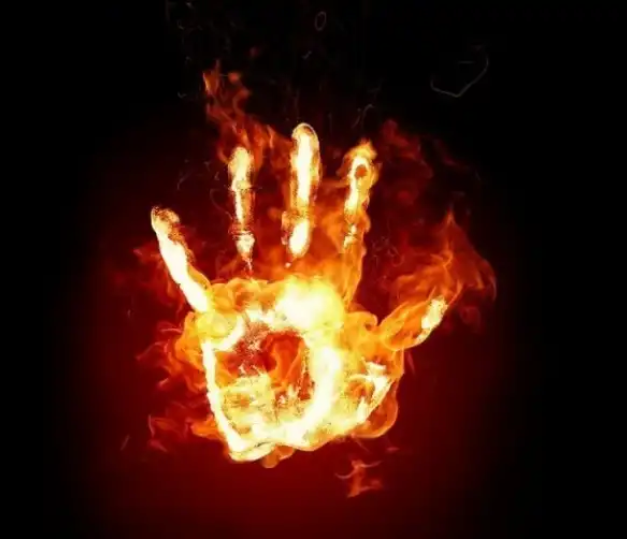    Мифы про оказание первой помощи. Так как же правильнее будет, срочно пописать на это место или кефиром намазать? Или может сметаной лучше? Но ни то и ни другое не годится.
  Первый миф – это использование масел для ожогов, жиро, барсучий жир. Вот это вот делать ни в коем случае нельзя. Так как они создают термостат. В течении 5, 7 минут после нанесения масел оно еще держит тепло. И это тепло проникает в глубокие слои кожи. И поэтому самое главное – не создать термостатического действия.  Все мази термостатирующие. Это вредит. Поэтому будет лучше если ни делать ничего, чем наносить какую-то мазь.
 Второй миф – использование таких агрессивных средств как спирт. Те, которые будут раздражать или усиливать болевые ощущения. Они являются проводником для проведения тепла в организм.

И сразу наводятся мысли так чем же мазать? А мазать ничем нельзя. Нужно знать, что делать сразу после ожога.
  Ребенка нужно раздеть, так как одежда пропитана этим горячим раствором и будет раздражать кожу. Также снять то что попало на кожу – это может быть и каша, и горячая жидкость и все что угодно, которое длительно действует. 
  И второе – это охладить. Но не очень холодной водой, температура должна быть не ниже 10 градусов. В течении 5-10 минут охладить. Это все, что нужно.
Обязательно обращайтесь к врачу. Так как кожа ребенка и взрослого это разные вещи. Ребенок должен наблюдаться у врача до периода окончания роста 18 лет. Так как у них на коже выявляется выделительная система, у них кровоток на коже в 5 раз выше, чем у взрослого, ребенок растет, а рубец – нет.  Этот рубец задерживает рост различных областей тела, с развитием различных деформации, когда не развивается сустав, когда выворачиваются пальцы, суставы и т.д.
  Не забудьте поставить лайк и подписывайтесь на мой канал, чтобы не пропустить полезных публикаций! Поделитесь с друзьями в социальных сетях, если Вам нравится.