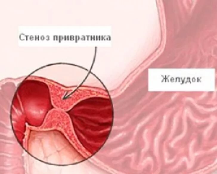 Гипертрофический стеноз привратника