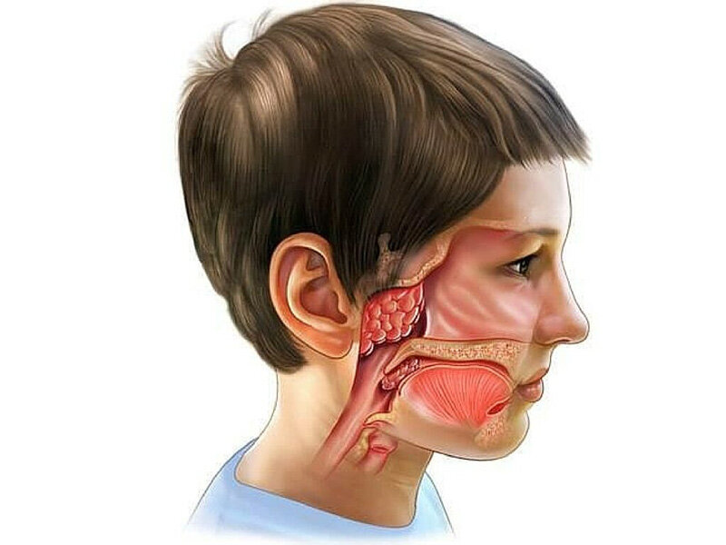 Увеличение или разрастания аденоидов (носоглоточный миндалины) можно считать одной из самых частых проблем в детском возрасте., особенно при значительной степени разрастания лимфоидной ткани.