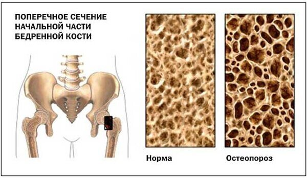 Процедура плотность костей как называется. Остеоденситометрия остеопороз. денситометрия костей остеопороз. плотность костей на остеопороз денситометрия. идиопатический ювенильный остеопороз.
