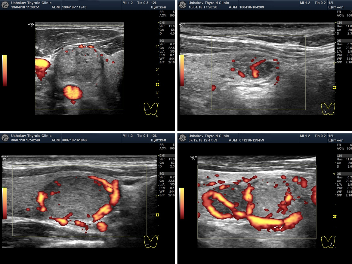 Щитовидная железа узи лимфоузлы. УЗИ щитовидной железы с допплерографией. Ультразвуковая допплерография сосудов щитовидной железы.. Ультразвуковое исследование щитовидной железы с ЦДК. УЗИ щитовидной железы с допплерографией сосудов.