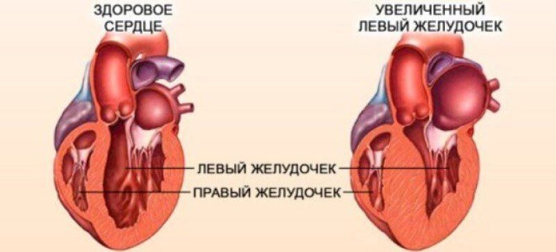 Желудочка сердца расширена. Гипертрофия стенок сердца. Утолщенные стенки сердца. Гипертрофия стенок левого желудочка.