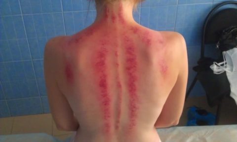  В области повреждения появляются ссадины и гематомы