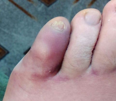  Основные симптоматические проявления нарушенной целостности мизинца нижней конечности