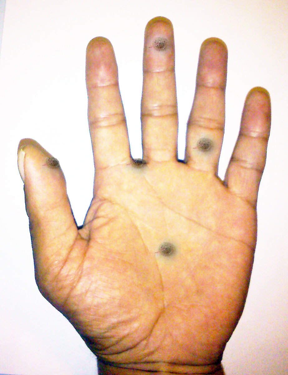 Вот так располагались бородавки на моей руке.  Все в тех местах,где особенно  дискомфортно.