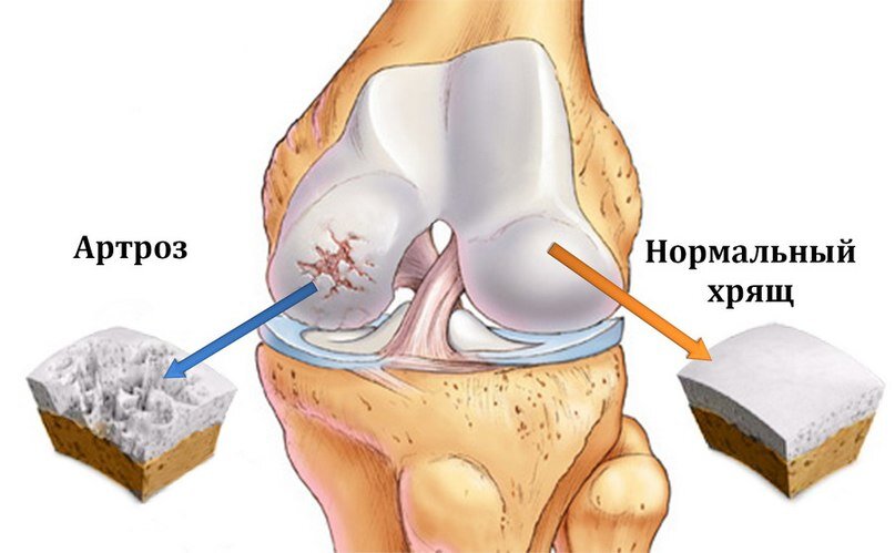 На фото коленный артроз. Источник: http://zdorov-vrn.ru/