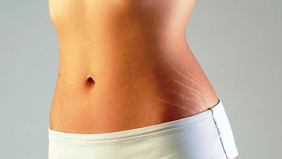 избавляемся от растяжек не выходя из дома