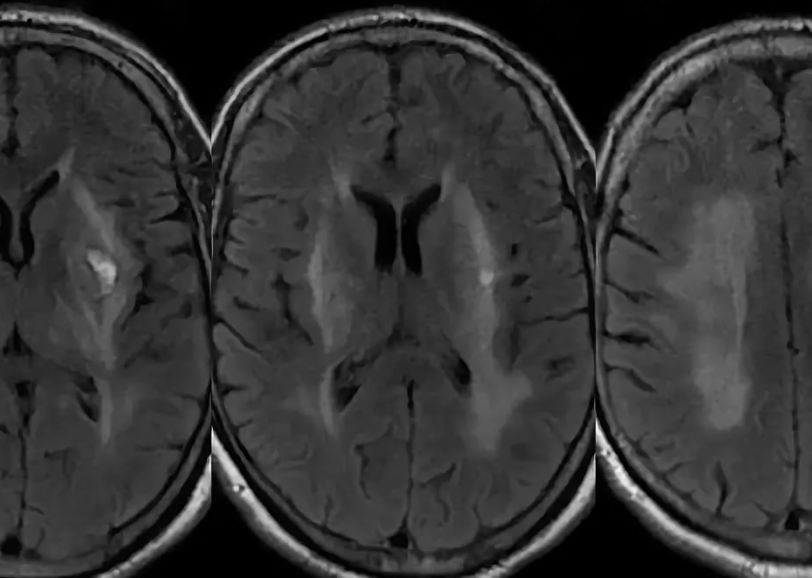 Энцефалопатия