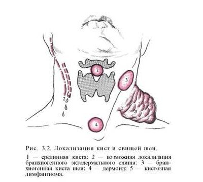 Кисты и свищи шеи