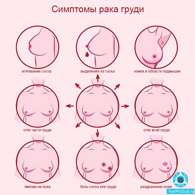 Как выглядит рак груди симптомы Рак молочной железы презентация онлайн