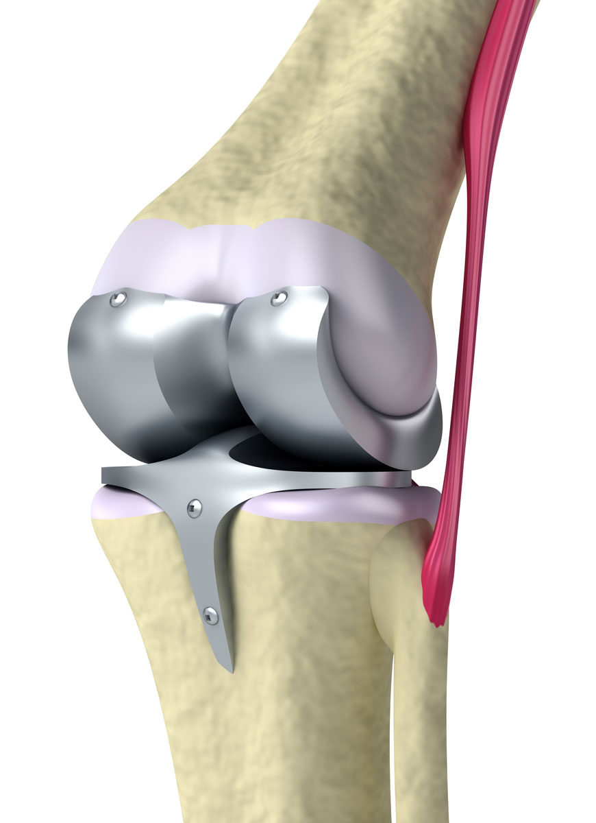Титановый эндопротез коленный. Гонартроз эндопротезирование коленного сустава. Артроз коленного сустава эндопротез.