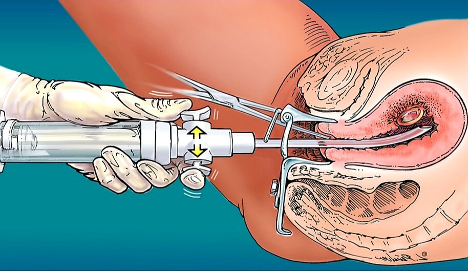 Процесс вакуумной чистки