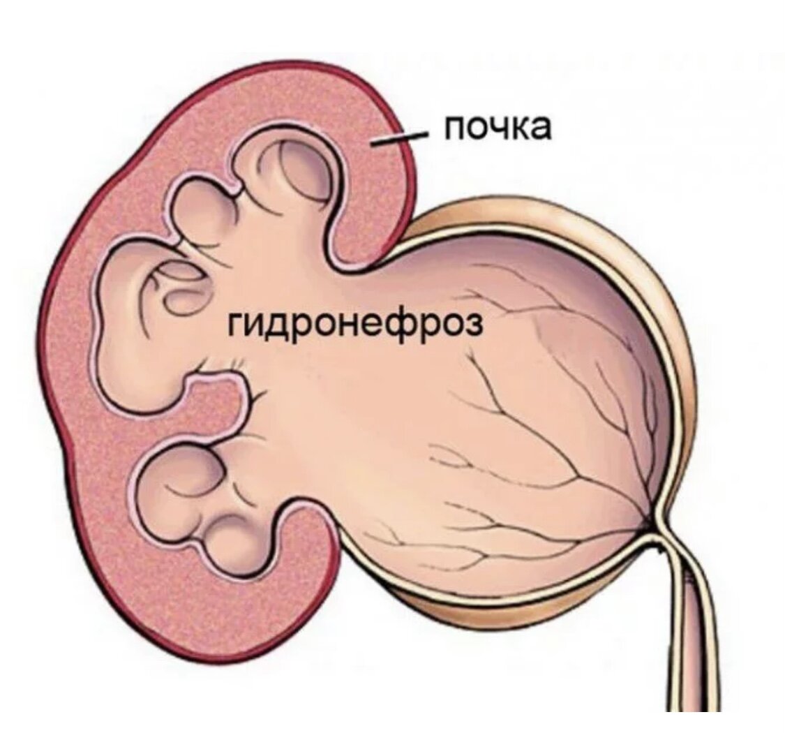 Почему лоханка. Расширение лоханки гидронефроз. Гидроуретеронефротическая трансформация почки. Расширение лоханки почки. Гидронефроз (водянка почки).