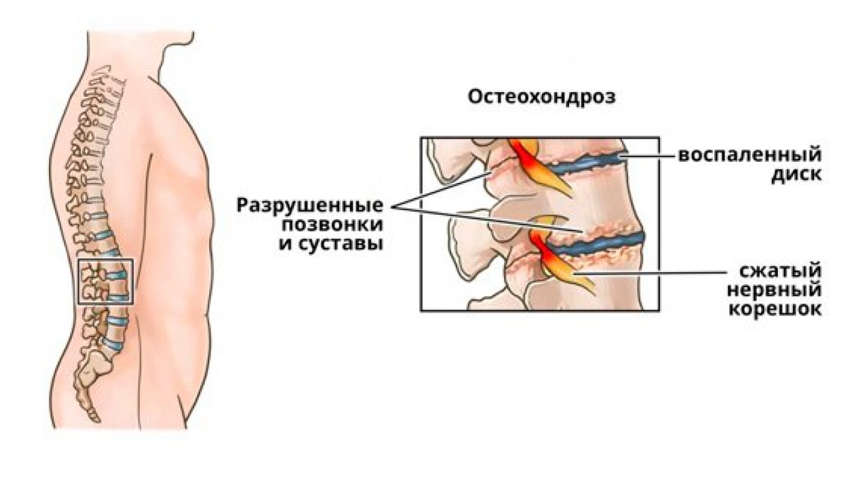 Остеохондроз поясничного отдела 1 2. Остеохондроз поясничного отдела симптомы у женщин. Срыв поясничного отдела. Поясничный остеохондроз симптомы у женщин. Остеохондроз поясницы симптомы у женщин.