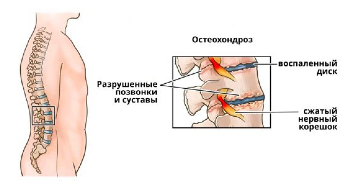 Остеохондроз поясничного отдела 2 период. Остеохондроз поясничного отдела симптомы у женщин. Срыв поясничного отдела. Поясничный остеохондроз симптомы у женщин. Остеохондроз поясницы симптомы у женщин.