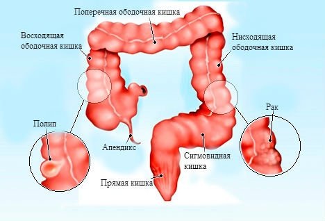 Сигмоидит: симптомы и лечение | Диагностика воспаления сигмовидной кишки в АО «Медицина»