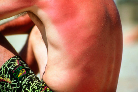  Гиперемия кожных покровов