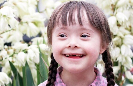 синдром дауна