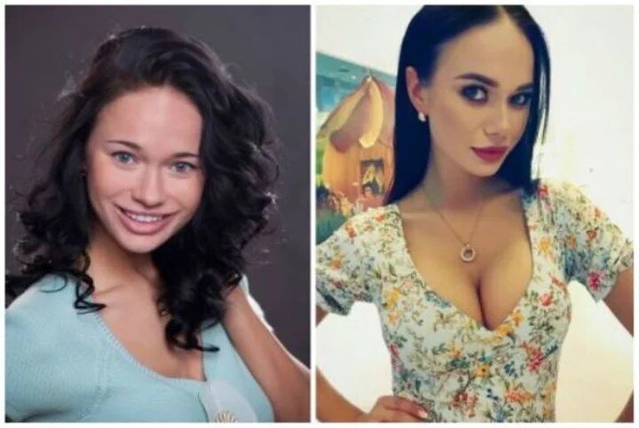 кошкина до операции и после