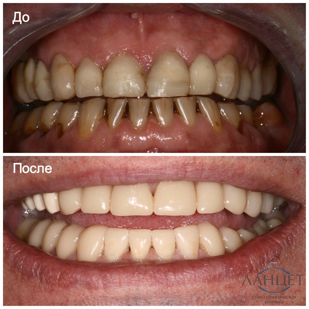 Виниры изготовлены на CEREC прямо в клинике
Врач Стрельцов Ю. Г.
