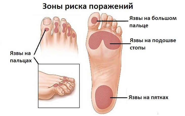 Зоны риска поражений стоп