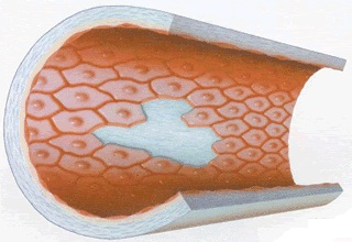 Повреждение эндотелия - основной фактор развития атеросклероза.