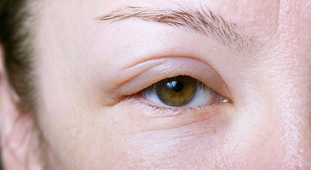 Отек век — это локальное избыточное накопление жидкости в веках. Отекать может только 1 веко: нижнее или верхнее (в большинстве случаев). Приступ может быть единичным или повторяющимся (рецидив).