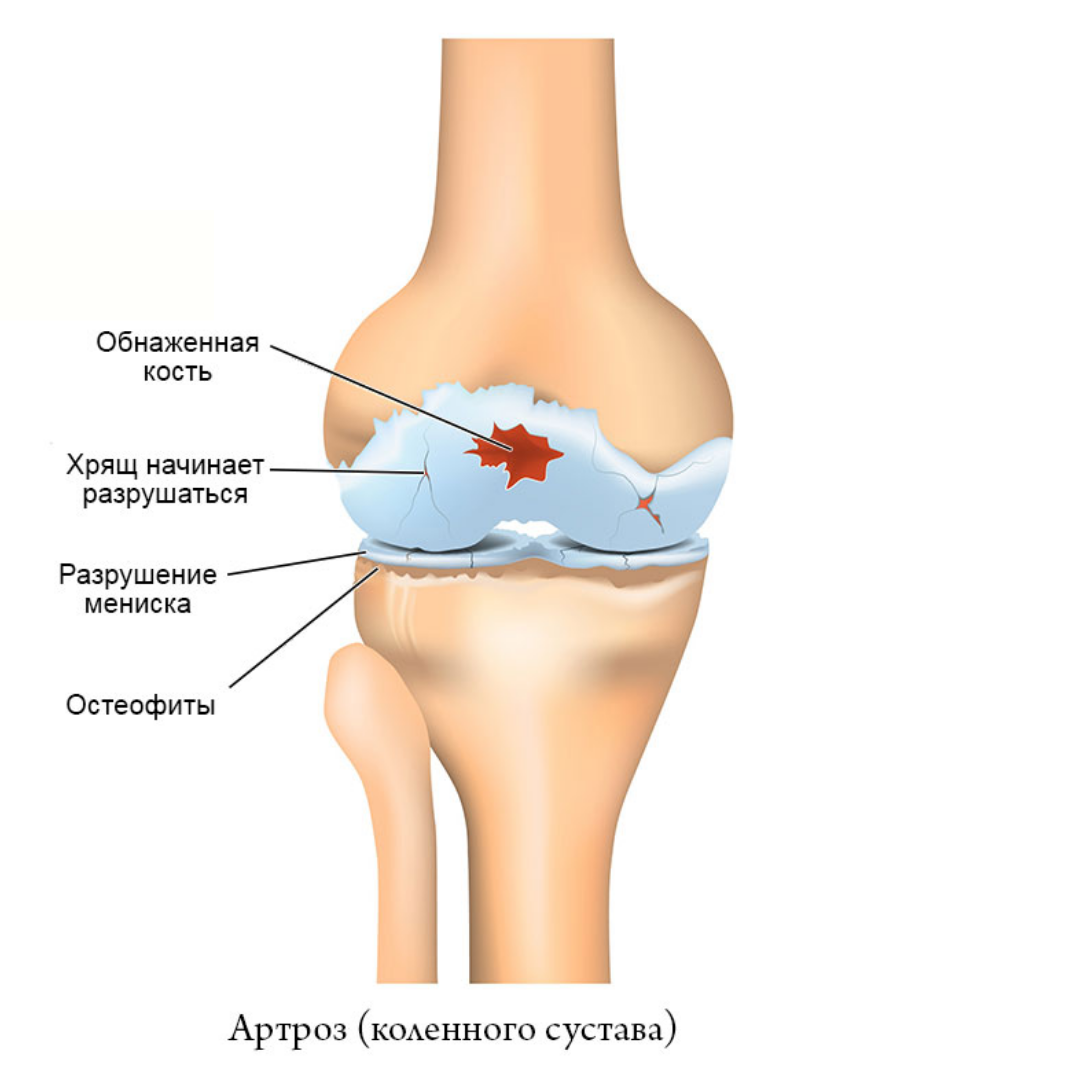 Артрит коленного сустава в домашних условиях. Артрит и артроз коленного сустава. Посттравматический артроз коленного сустава. Посттравматический артрит коленного сустава. Остеоартроза и артрита коленного сустава.