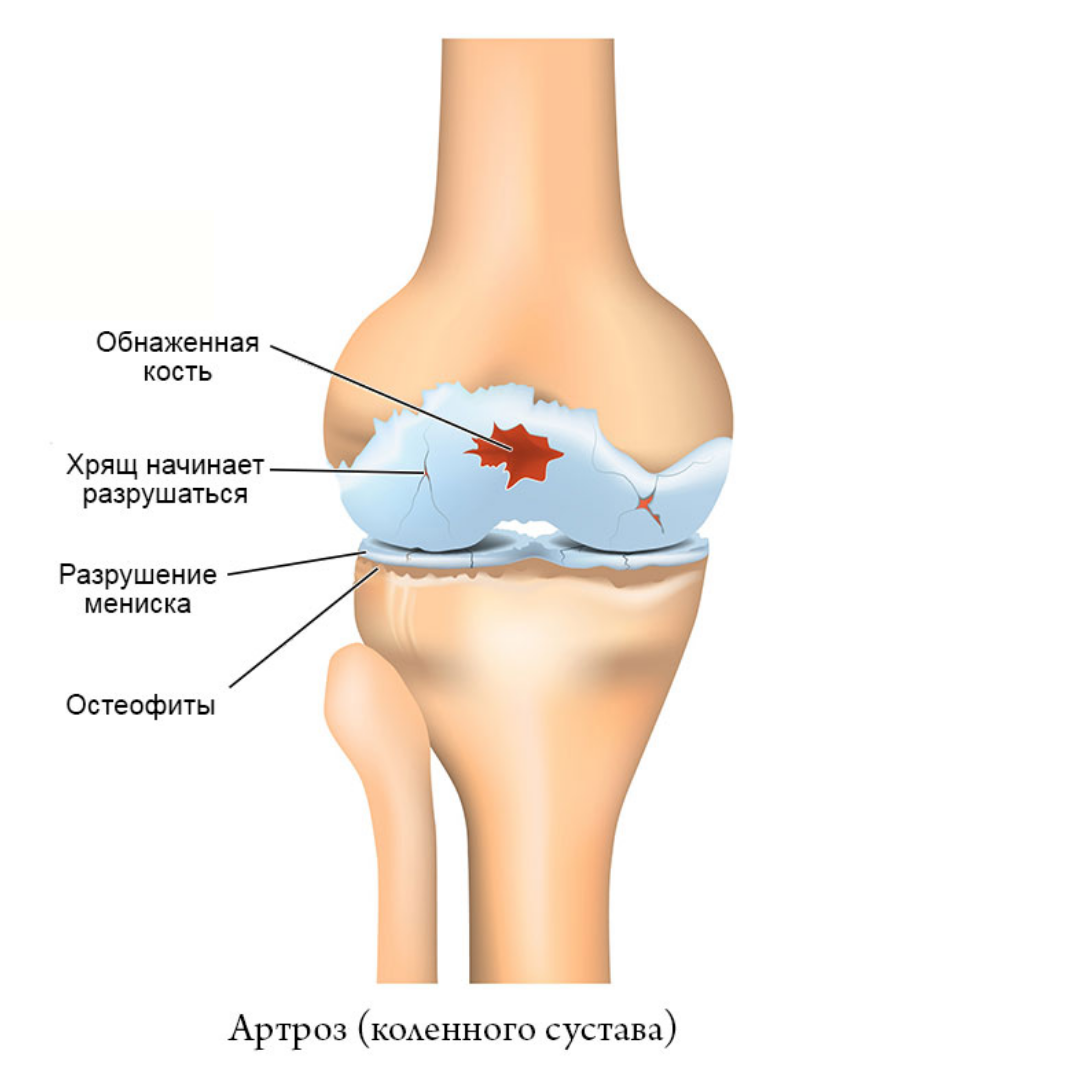 Остеоартроз и артрит. Артрит и артроз коленного сустава. Посттравматический артроз коленного сустава. Артроз коленного сустава 1 степени. Остеоартроза и артрита коленного сустава.