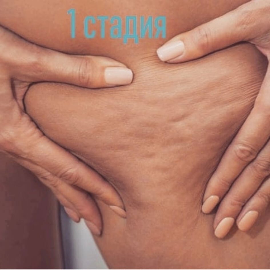 1 стадия целлюлита