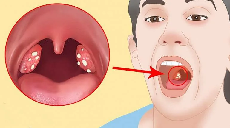 Откуда же гнойники появляются и почему от них довольно сложно избавиться?