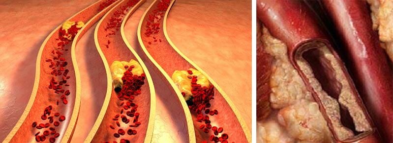 По данным Всемирной Организации Здравоохранения (ВОЗ) загрязнение сосудов является причиной до 93% развития различных заболеваний: от заболеваний кишечно-желудочного тракта до ухудшения зрения
