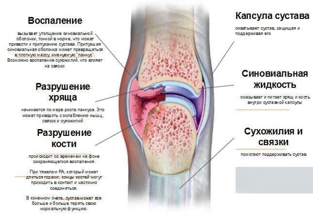 Что такое ревматоидный артрит артрит? Симптомы ревматоидного артрита и лечение суставов