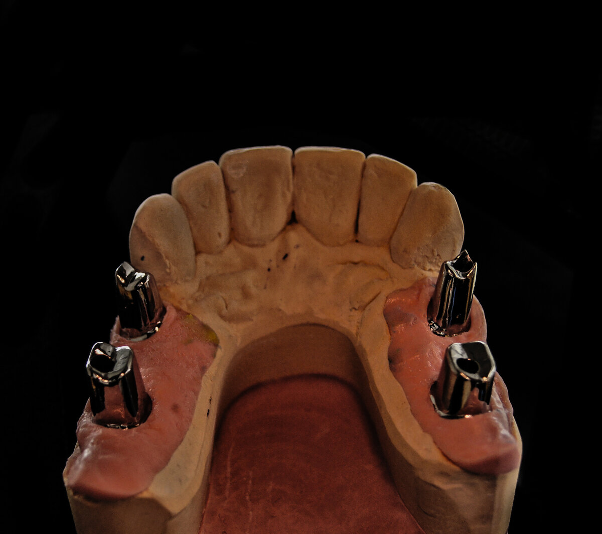 Индивидуальные абатменты - это вид протетики на который потом устанавливается итоговая коронка (крепится к имплантату сверху с помощью винта). (Считается более интересным решением (чем стандартные), так как изготавливается под каждого пациента свой, соответственно, индивидуально)