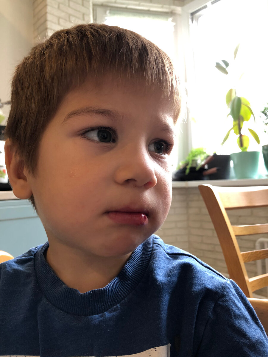 Разбил губу и грустит 