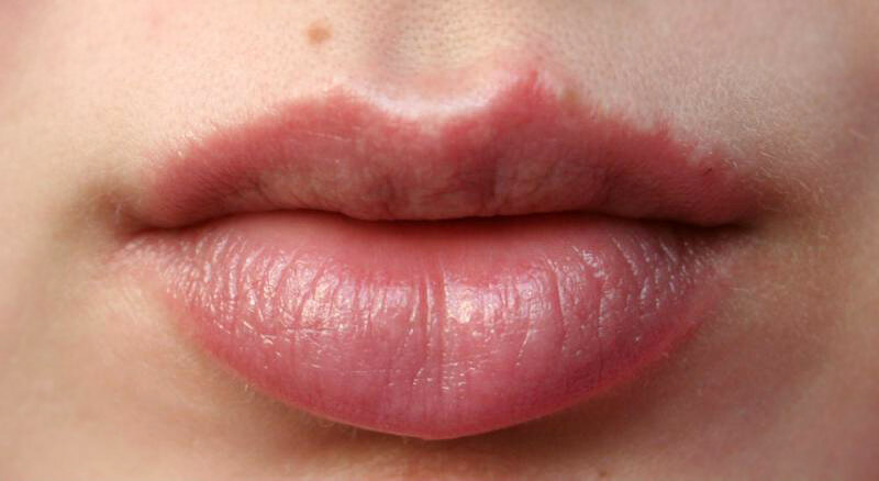 Герпес на губах: лечение народными средствами быстро | Новини