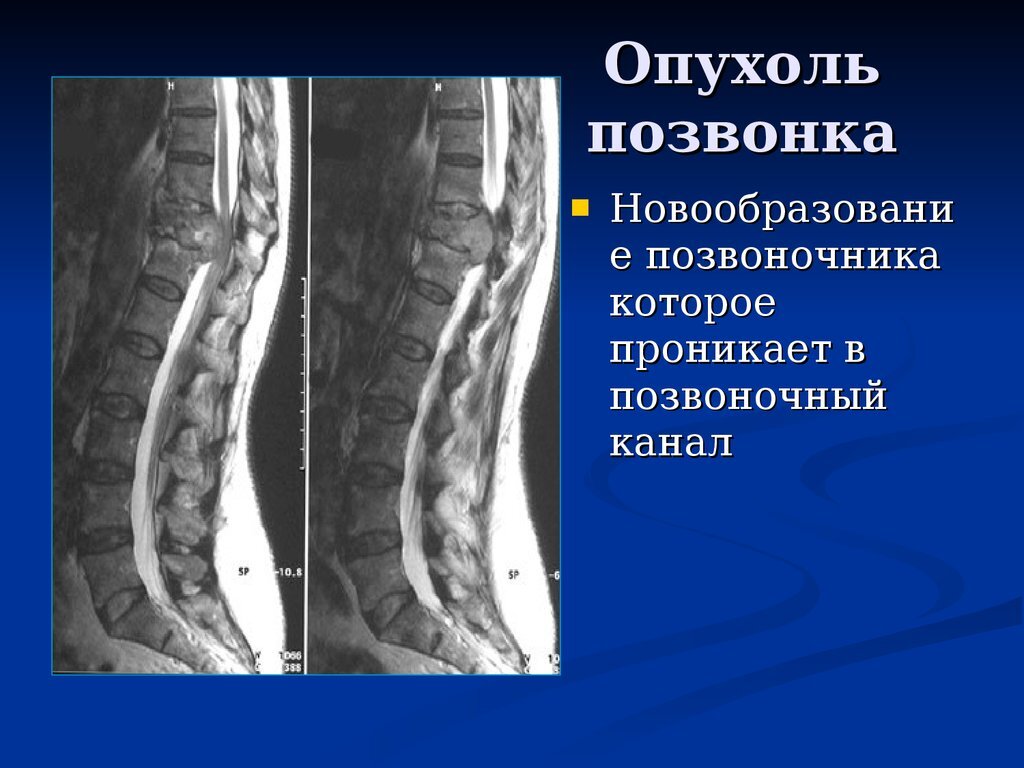 Опухоль в поясничном отделе. Объемное образование позвоночника.