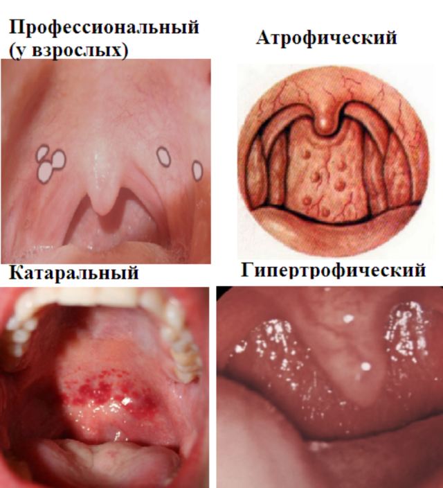 Ларингит - лечение у взрослых, симптомы, диагностика и рекомендации| СМ-Клиника в Санкт-Петербурге