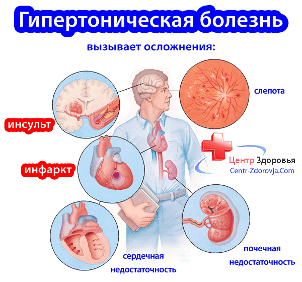 Гипертонический криз: причины, симптомы, первая помощь, лечение