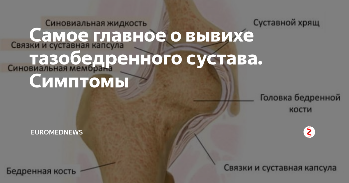 Врожденный вывих бедренного сустава. Задненижний вывих бедра. Связка головки бедренной кости растяжение. Подвывих тазобедренного сустава симптомы. Дисплазия головки бедренной кости.
